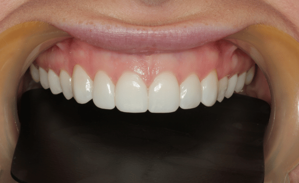 After - Creffield Lodge Dental Practice