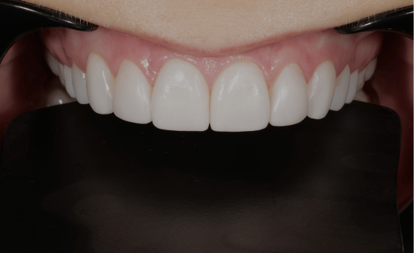 After - Creffield Lodge Dental Practice