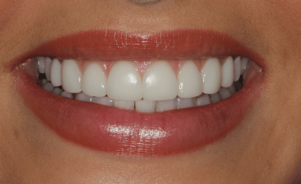 After - Creffield Lodge Dental Practice