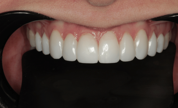 After - Creffield Lodge Dental Practice