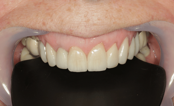 After - Creffield Lodge Dental Practice