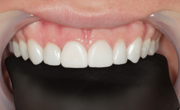 After - Creffield Lodge Dental Practice