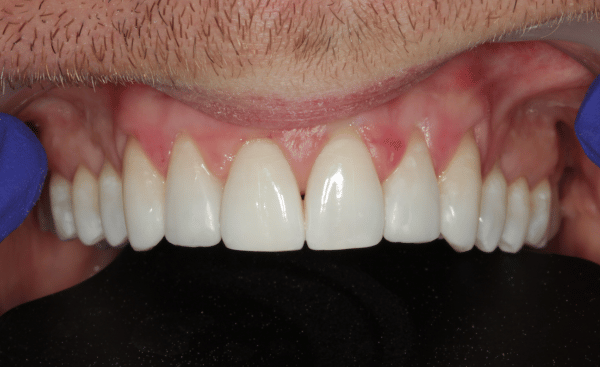 After - Creffield Lodge Dental Practice