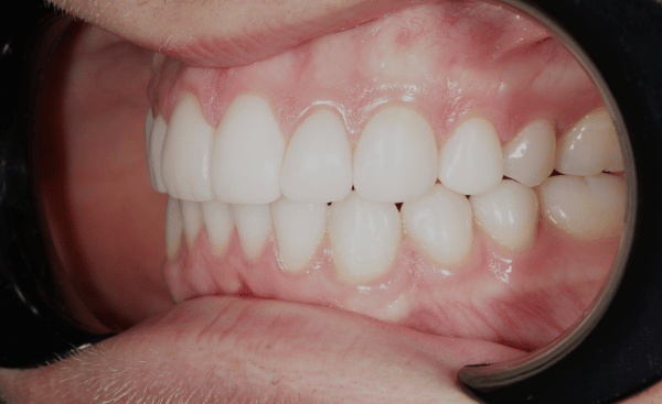 After - Creffield Lodge Dental Practice