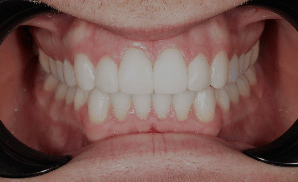 After - Creffield Lodge Dental Practice