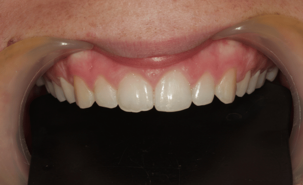 After - Creffield Lodge Dental Practice