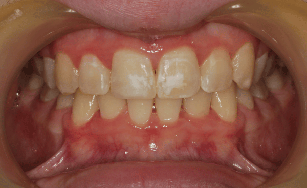 After - Creffield Lodge Dental Practice