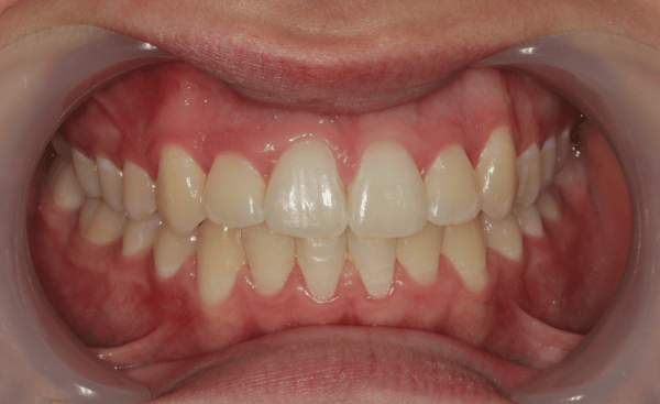 After - Creffield Lodge Dental Practice