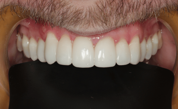 After - Creffield Lodge Dental Practice